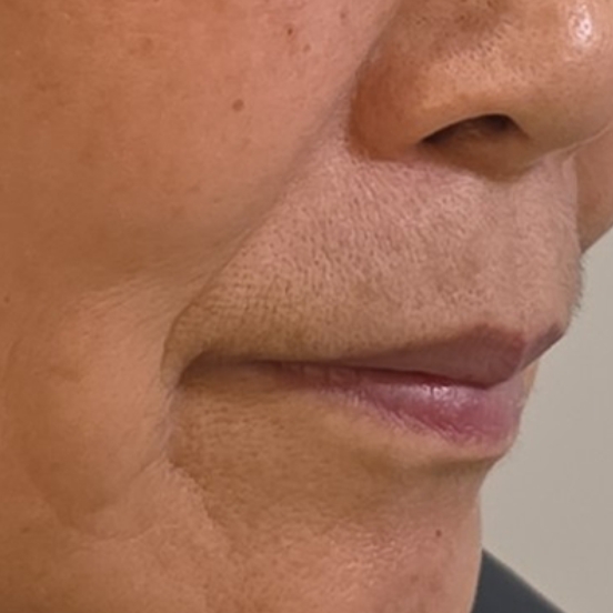 인천 팔자주름 필러 쥬베룩볼륨 실리프팅 초음파리프팅 비교